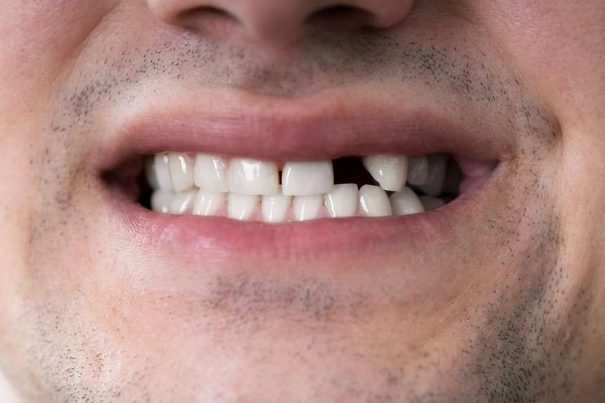 Zahnfehlstellung Hypodontie Zahnlücke Lücke fehlende Zähne Gap